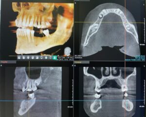 Referto TAC dentale 3D
